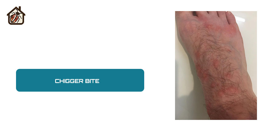 Chigger bite skin